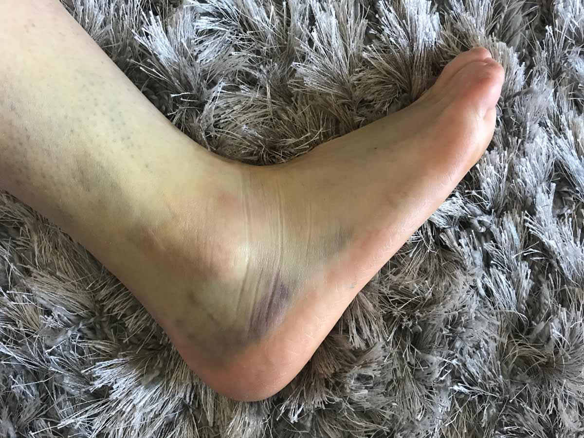 How to recover from a sprained ankle 3 trail and kale